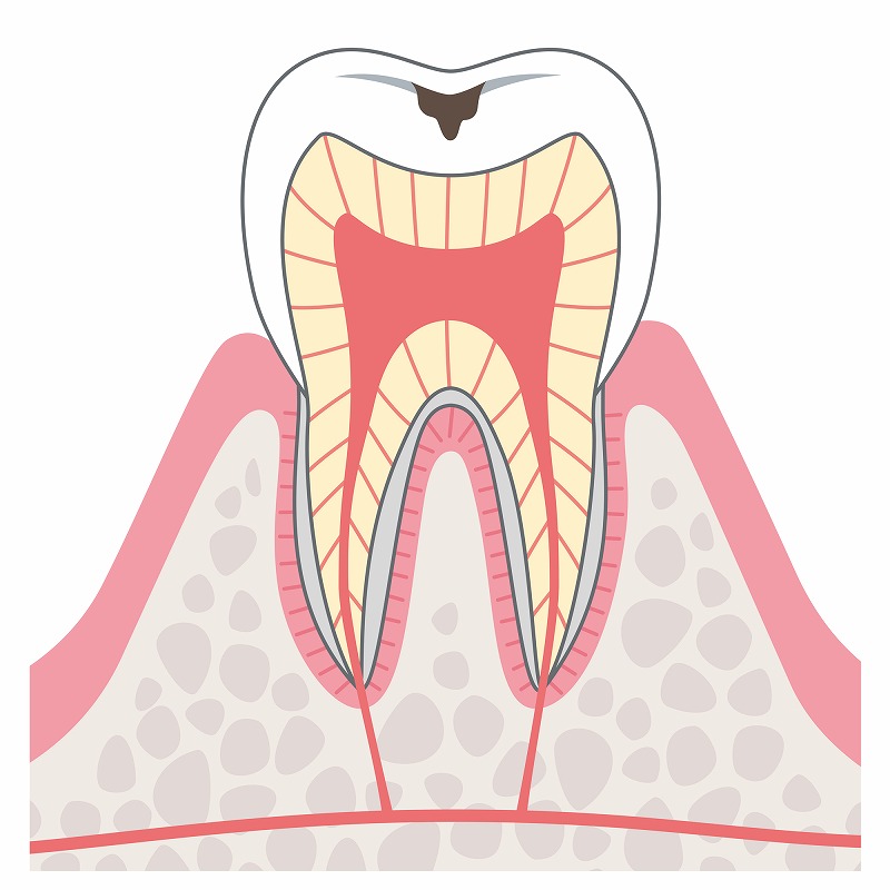 歯のエナメル質が溶け始める