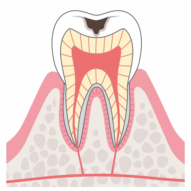 むし歯が象牙質まで浸食する