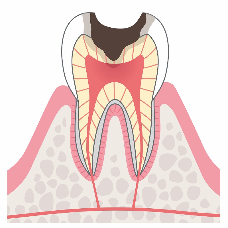 むし歯が神経に到達する