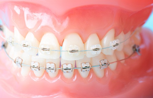 ブラケットとワイヤー治療